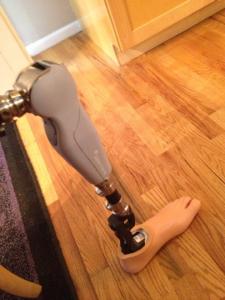 Microprocessor Knee and Talux Feet by Ossur Prosthetics